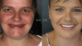 COSMETIC DENTISTRY AND VENEERS