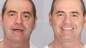 COSMETIC DENTISTRY AND VENEERS