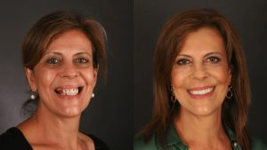 COSMETIC DENTISTRY AND VENEERS