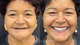 COSMETIC DENTISTRY AND VENEERS