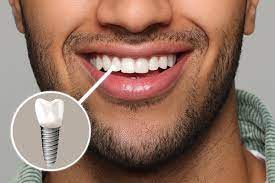 Dental Implants in White Plains, NY: Restoring Smiles and Confidence