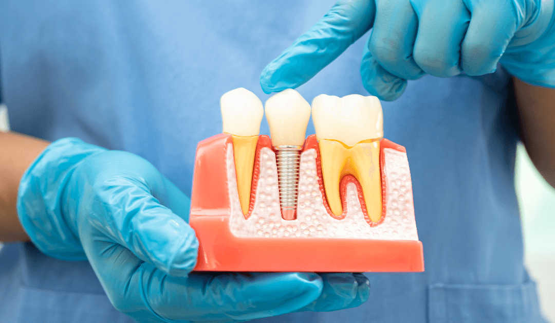 Cost Considerations for Dental Implants: What to Expect