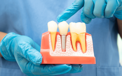 Cost Considerations for Dental Implants: What to Expect