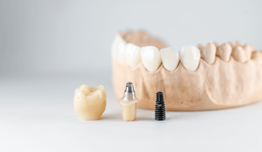 The Crucial Role of Dental Implants in Restoring Missing Teeth