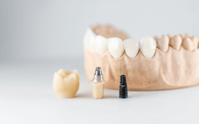 The Crucial Role of Dental Implants in Restoring Missing Teeth