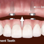 Teeth Replacement