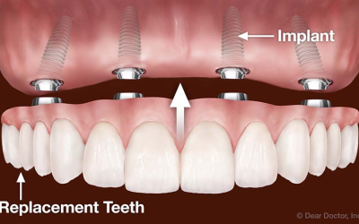 Single Tooth Replacement vs. Multiple Tooth Implants: What’s Best For You?