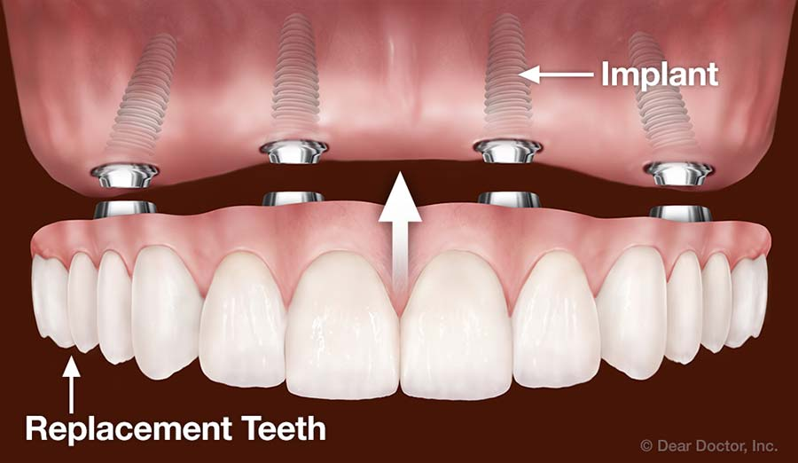 Teeth Replacement